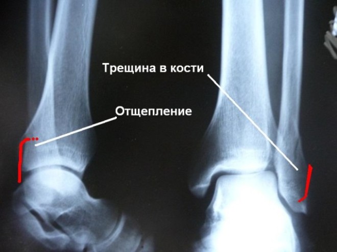 Трещина кости голеностопного сустава на рентгенограмме