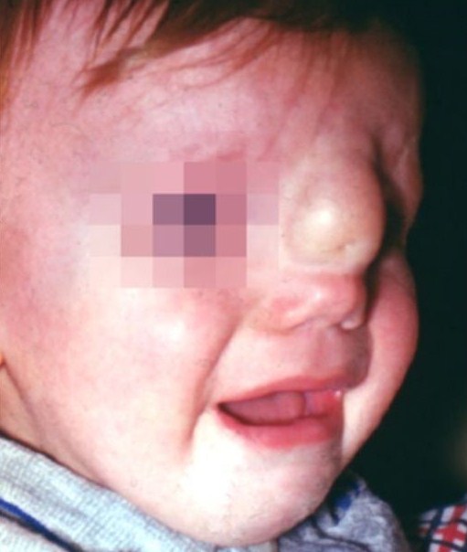 Дермоидная киста носа у ребенка