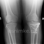 Рентгеновский снимок коленный сустав