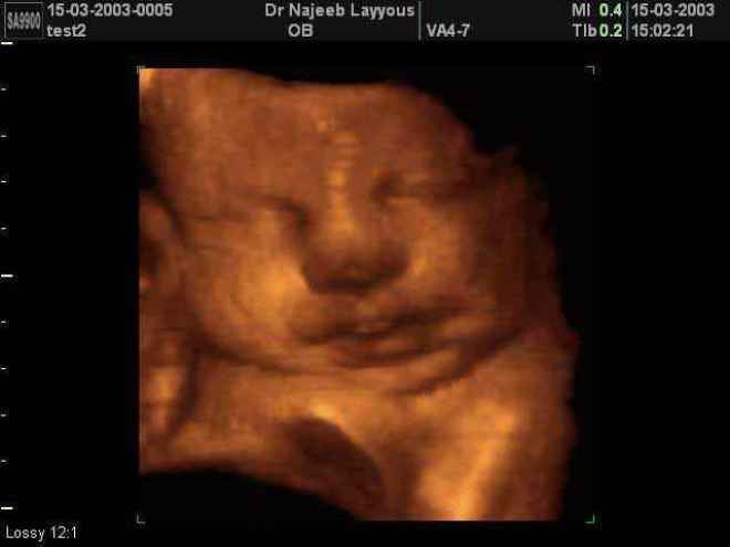 Снимок плода на 3Д УЗИ на 38 неделе беременности