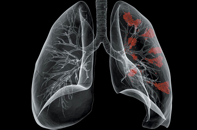 КТ-исследование легких: клинические показания и возможности визуализации