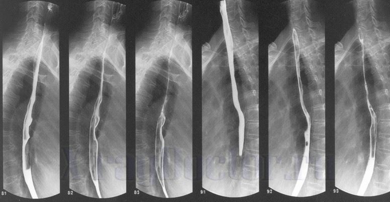 Рентгеноскопия пищевода: показания и диета