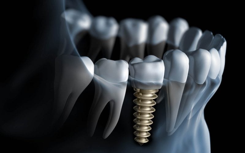 3D-снимок зубов: для чего нужно и что показывает