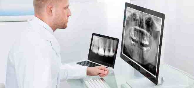 Для чего проводится рентген зубов
