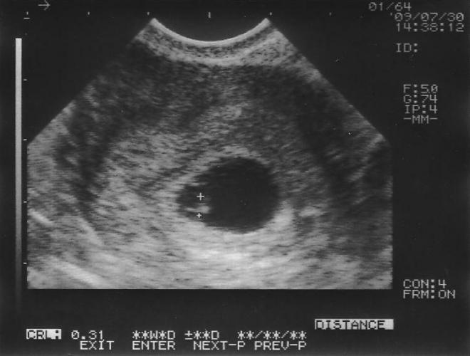 Снимок УЗИ на 6 неделе беременности