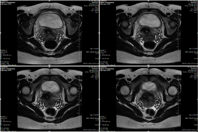 Снимок МРТ органов малого таза женщины