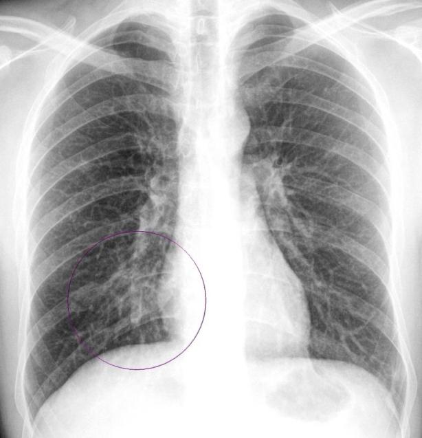 Как выглядит рак легких на рентгене фото у человека