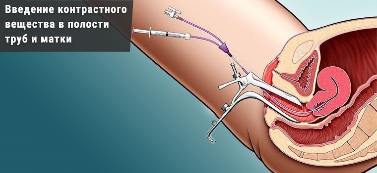 Рентген маточных труб: назначение и особенности проведения процедуры