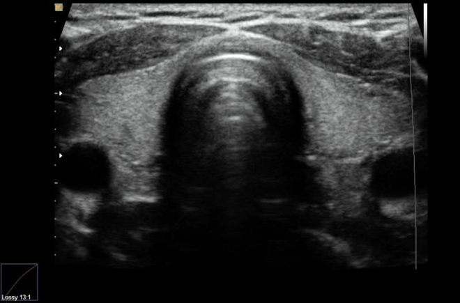 Снимок УЗИ щитовидной железы