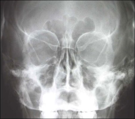 Для чего используют рентген пазух носа?