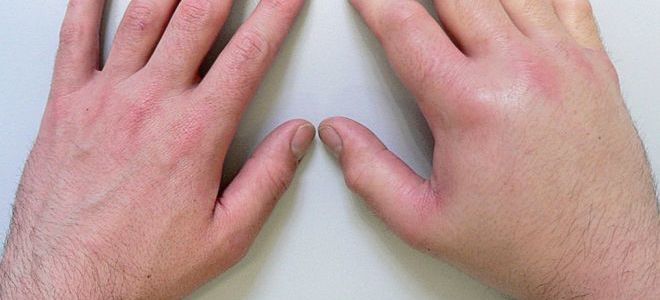 Показания и методика проведения МРТ кисти руки
