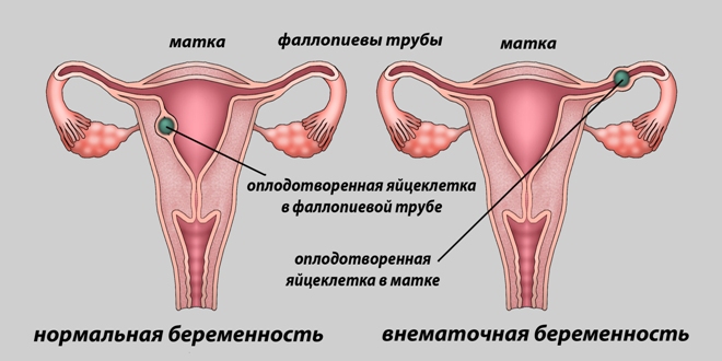 Пример внематочной беременности