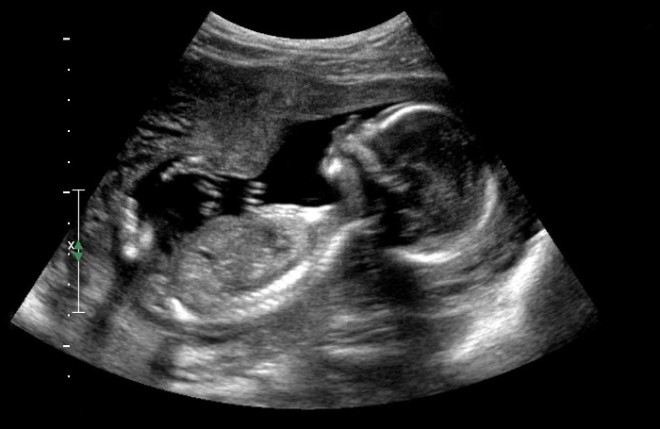 Снимок УЗИ плода на 18 неделе беременности