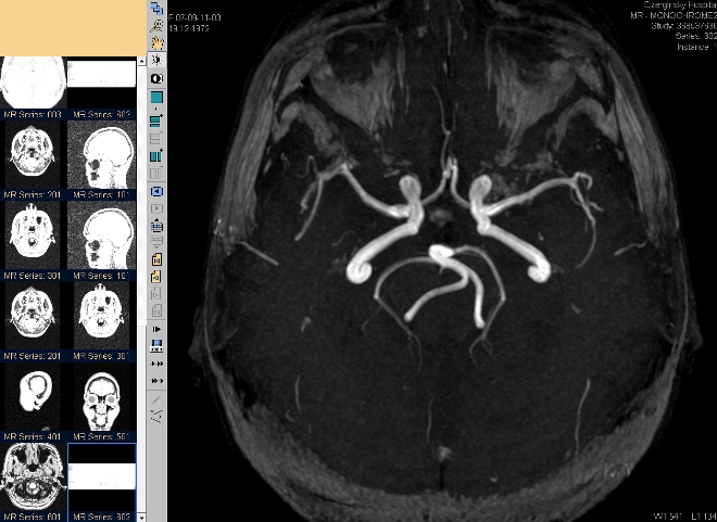 Снимок сосудов головного мозга на МРТ