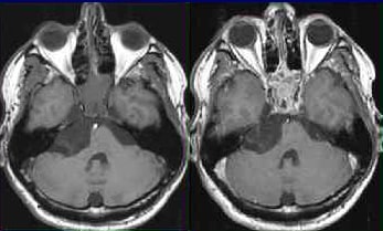 МРТ при опухолях головного мозга: классификации, снимки