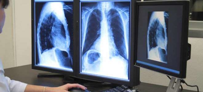 В каких случаях назначается рентген при пневмонии