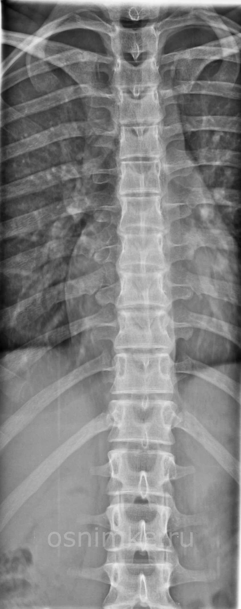 Рентгеновский снимок позвоночника