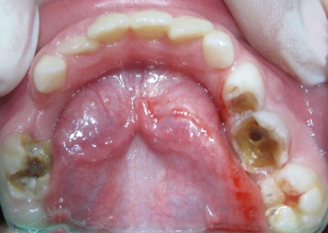 Заболевание зуба
