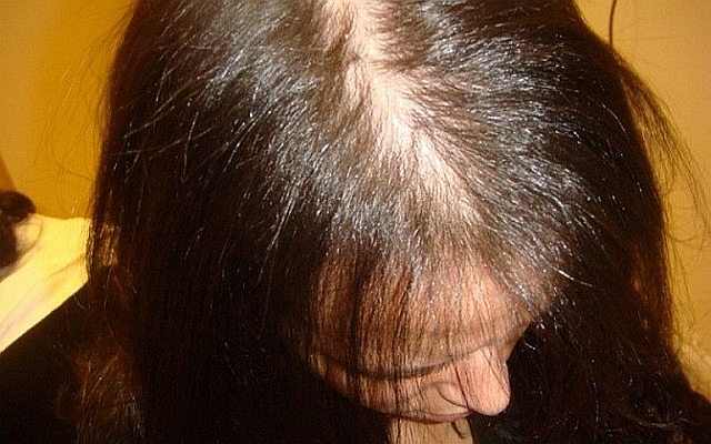 Гормоны влияющие на выпадение волос при гормональном сбое
