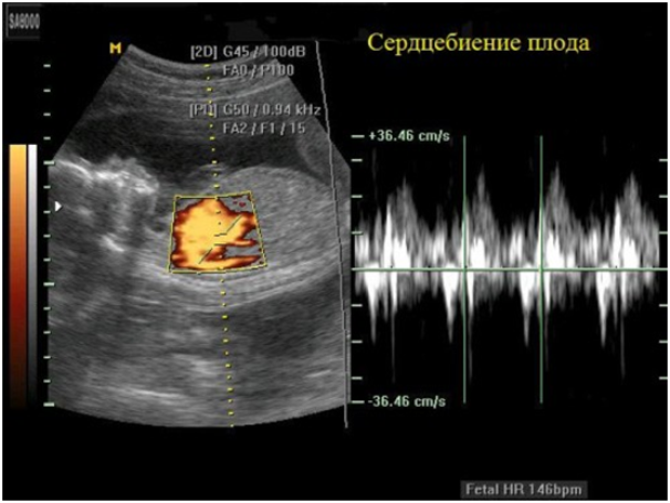 Сердцебиение плода на УЗИ