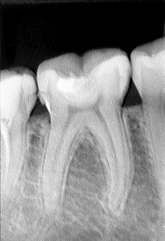 Прицельный снимок зуба: рентгеновские снимки, доза облучения