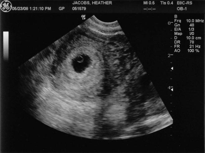 Снимок УЗИ на первом месяце беременности