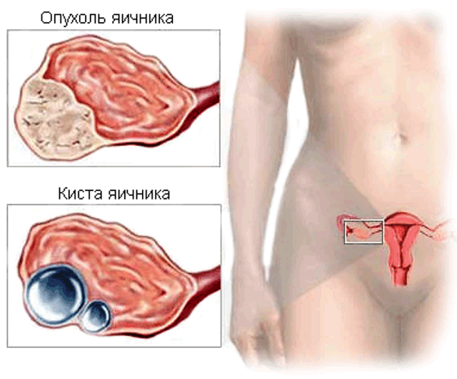 Отклонения яичника у женщин