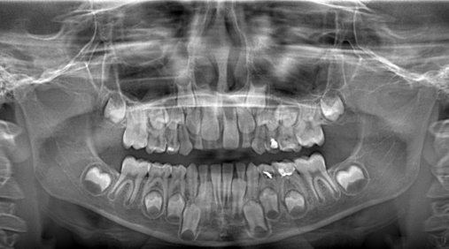 Виды диагностики рентгена зубов ребенка