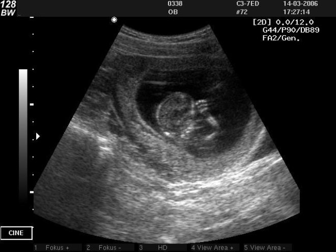 Снимок УЗИ при беременности