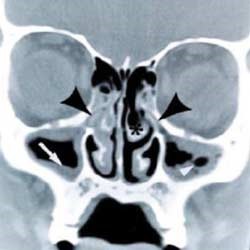 Фото компьютерной томограммы при риносинусите. Белыми стрелками указан отек слизистой в верхнечелюстных пазухах, черными - в ячейках решетчатой кости и полости носа.