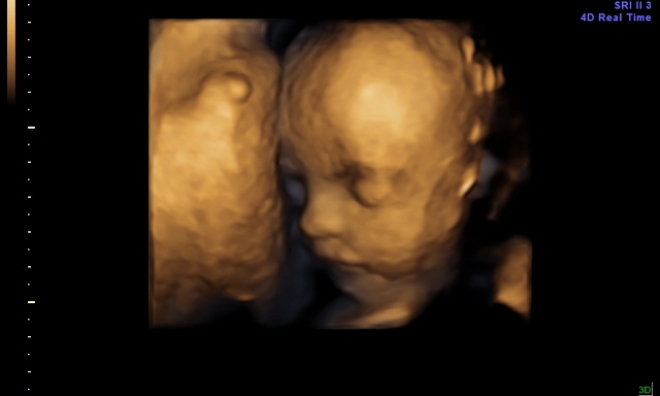 Снимок 3Д УЗИ на 25 неделе беременности