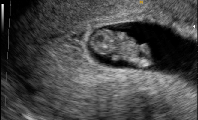 Снимок УЗИ на 9 неделе беременности