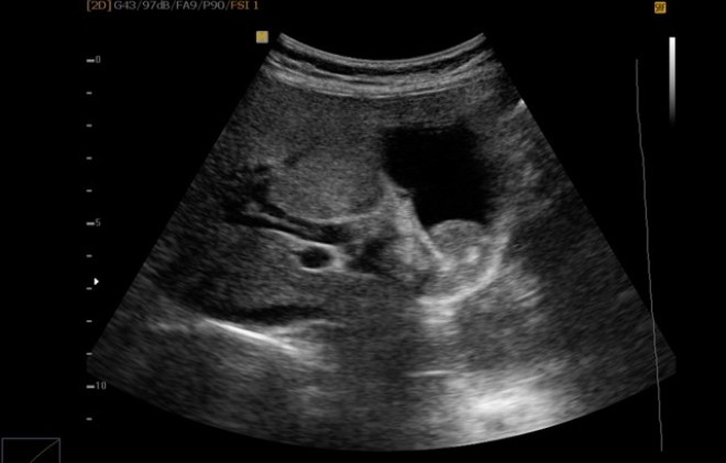 Снимок УЗИ брюшной полости при беременности