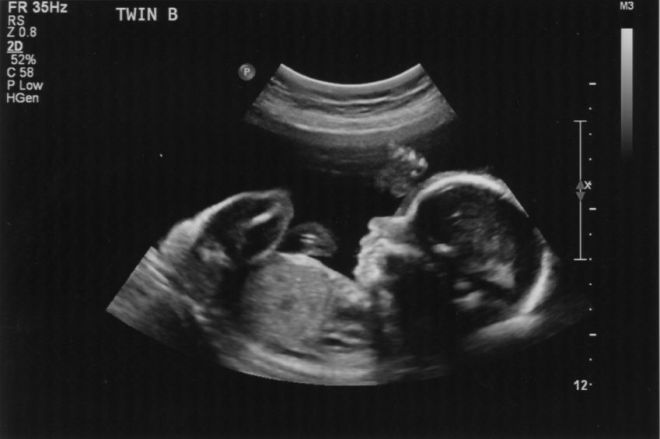 Снимок УЗИ на 37 неделе беременности