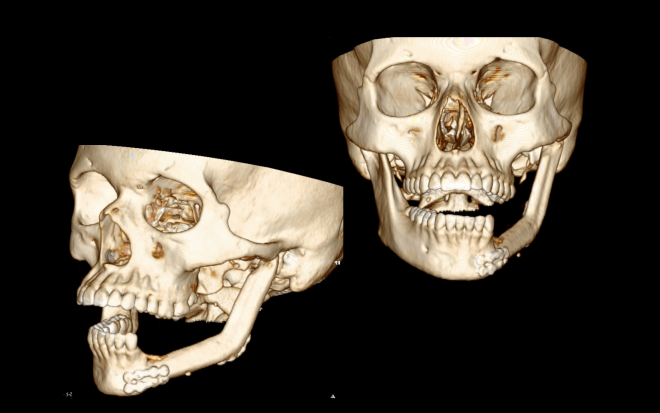 Снимок КТ костей черепа