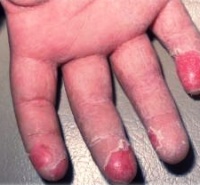 Шелушится кожа на руках почему трескается кожа локтей и на пальцах