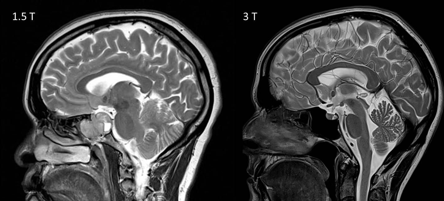 Достоинства МР-диагностики при рассеянном склерозе: с контрастом