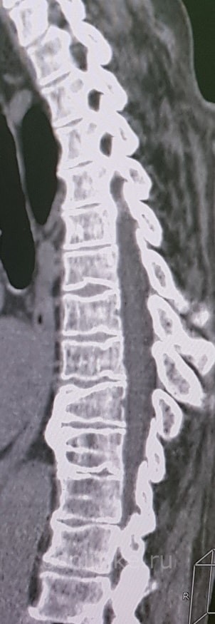 Деформирующий спондилёз 3 стадии, распространённый остеохондроз