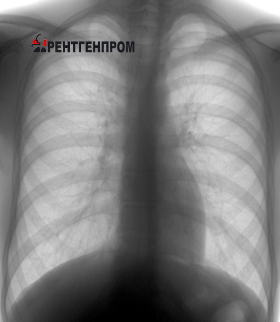Здоровые лёгкие. Обзорный снимок грудной клетки