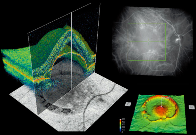 Моделирование состояния глаза с помощью оптической когерентной томографии