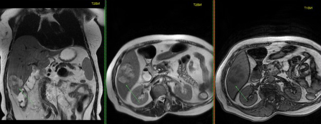 Снимок компьютерной томографии с болюсным контрастированием