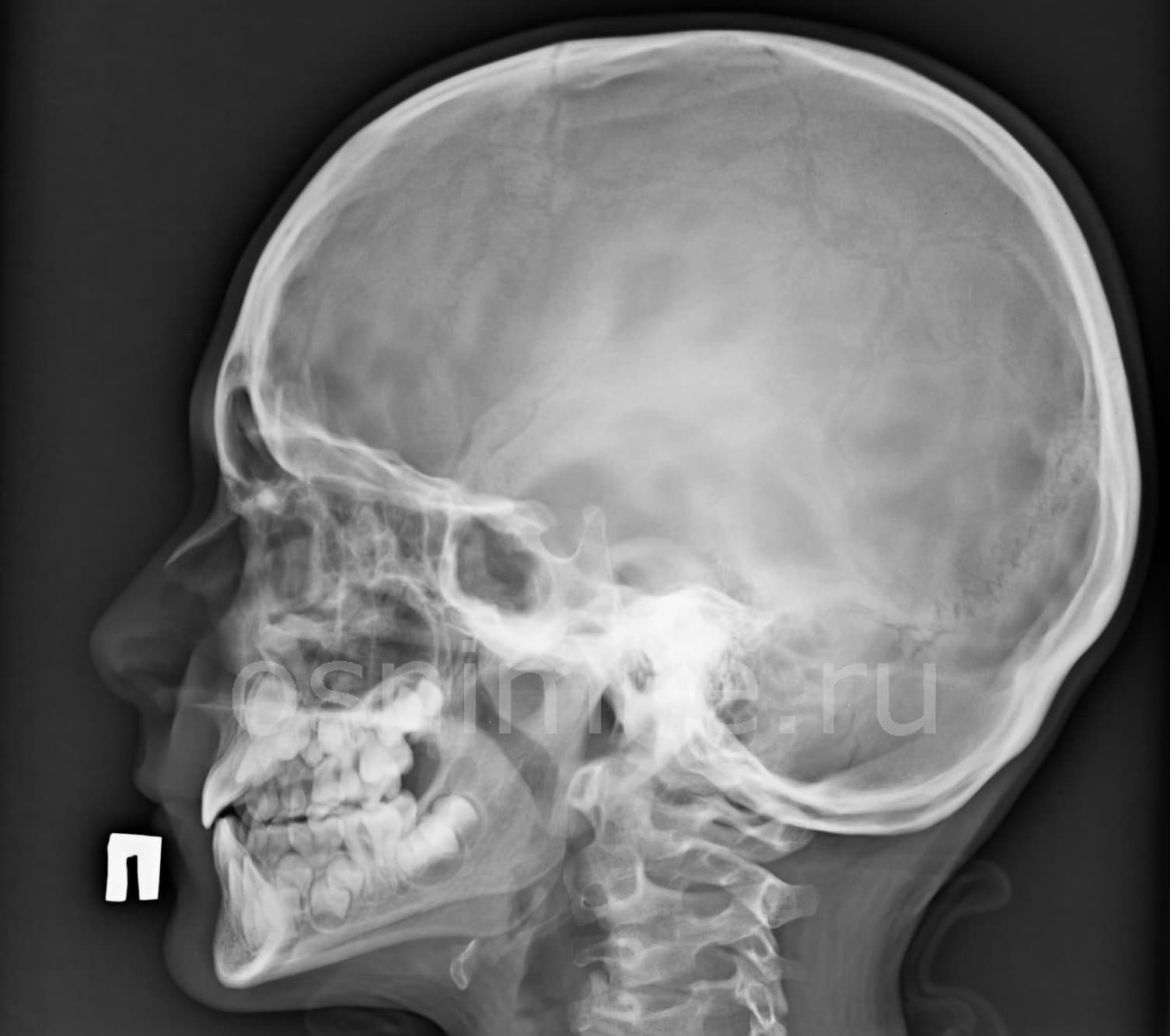 Рентген костей черепа в 2 проекциях