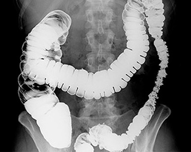 Рентген кишечника с барием: показания и особенности проведения процедуры