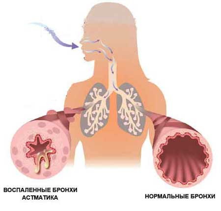 Бронхиальная астма: симптомы, лечение, неотложная помощь в домашних условиях