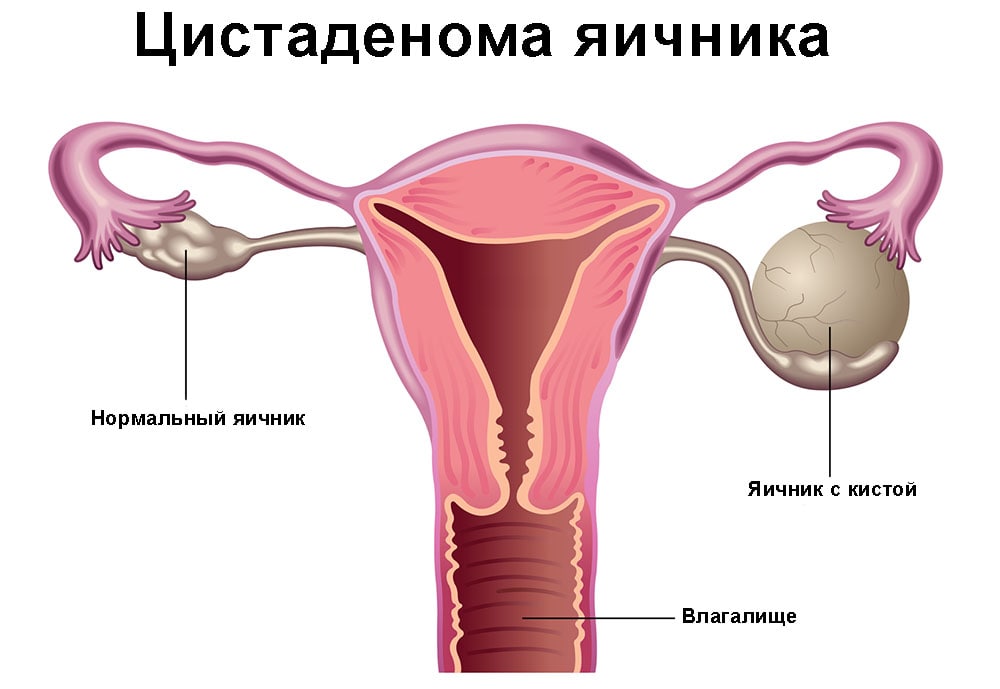 Магнитно-резонансная томография матки и яичников: показания