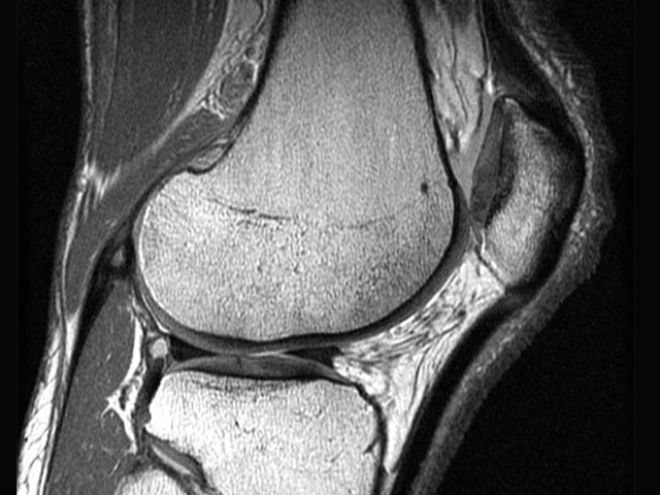 Снимок коленного сустава на МРТ