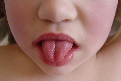Скарлатина у детей симптомы и лечение в домашних условиях