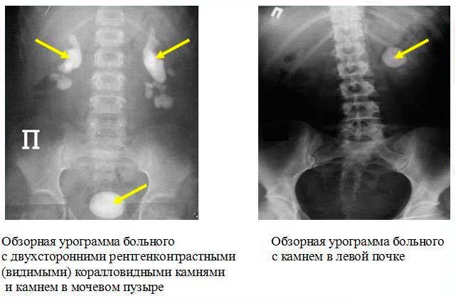 Рентген почек с контрастным веществом: особенности проведения исследования