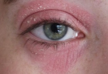 покраснение кожи вокруг глаз - причины средства для кожи