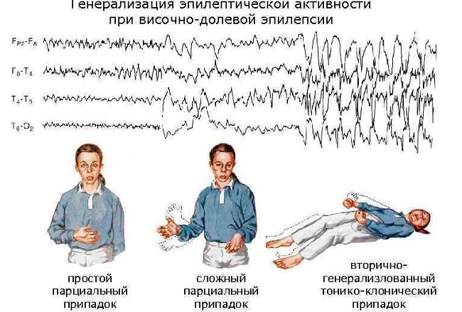 Эпилепсия: симптомы, причины и лечение